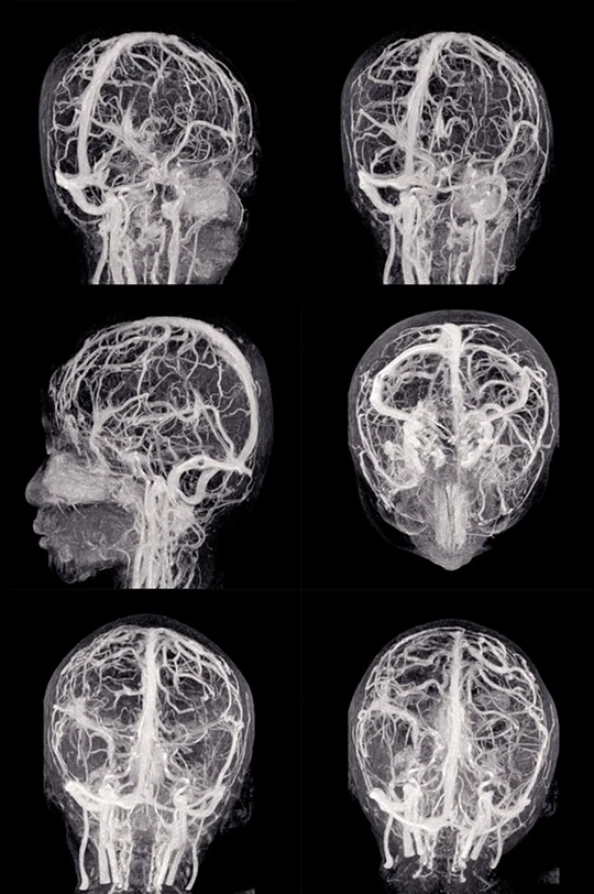 Neurofeedback Treatment Overview in Los Angeles 