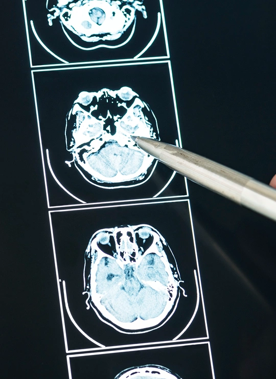 Neurofeedback Treatment Overview in Westlake Village